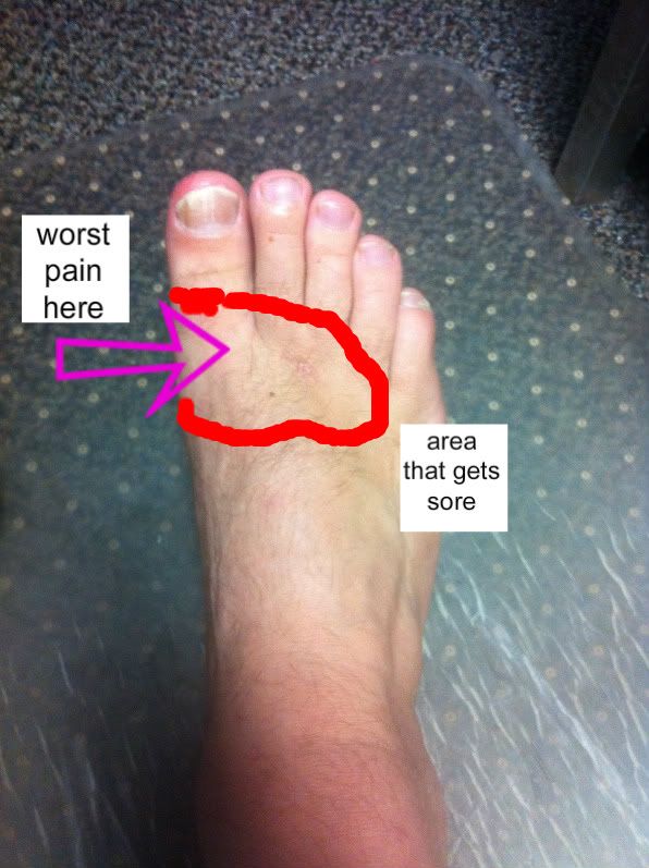 why-does-my-big-toe-hurt-community-foot-clinic-of-mcpherson